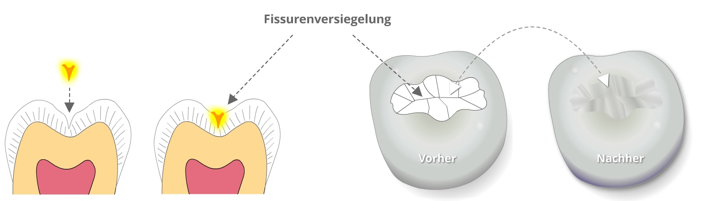 Fissurenversiegelung