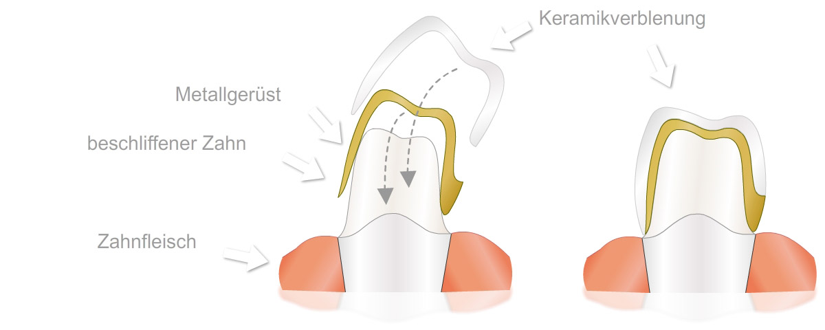 Keramik - Verblendkrone Dr. Hasan