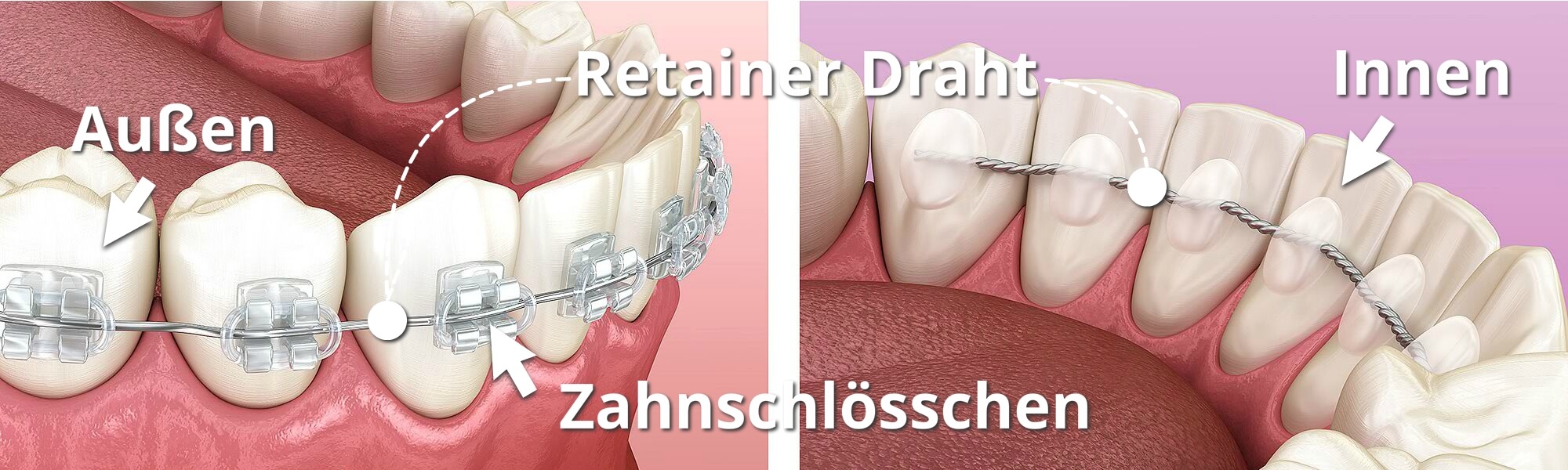 Illustration einer Ansicht an 2 Modellen mit einer Multiband-Apparatur Innen und Außen