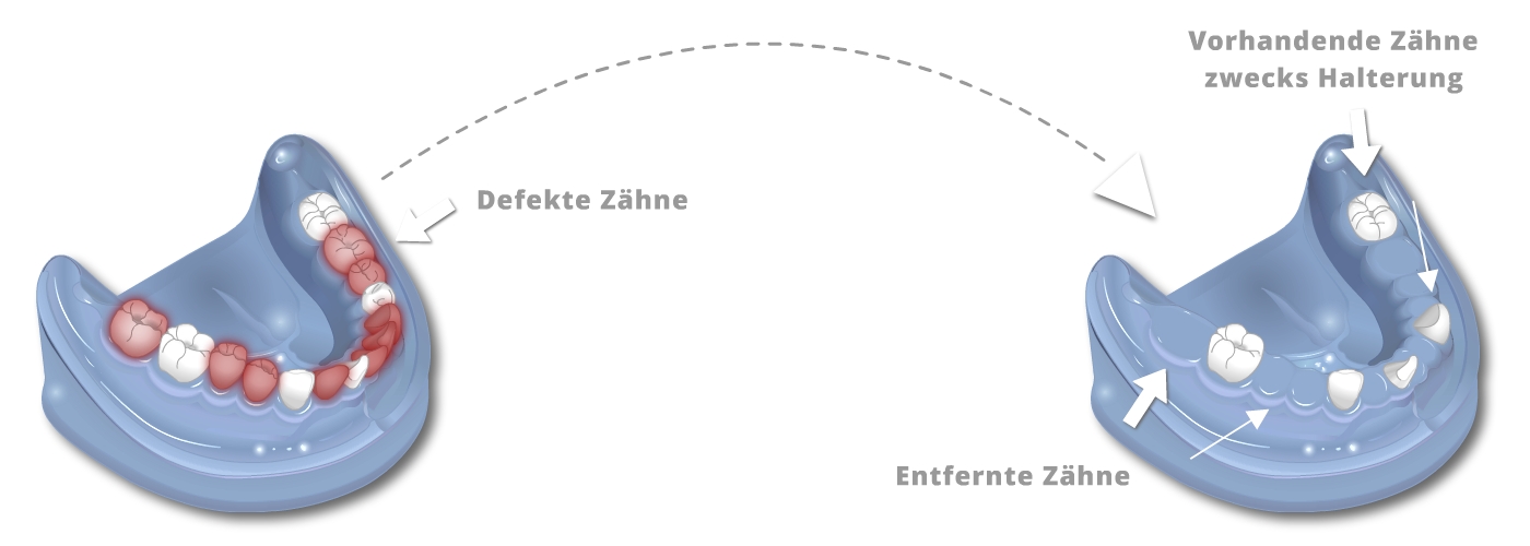 Ästhetischer Zahnersatz - Teleskope aus Vollkeramik