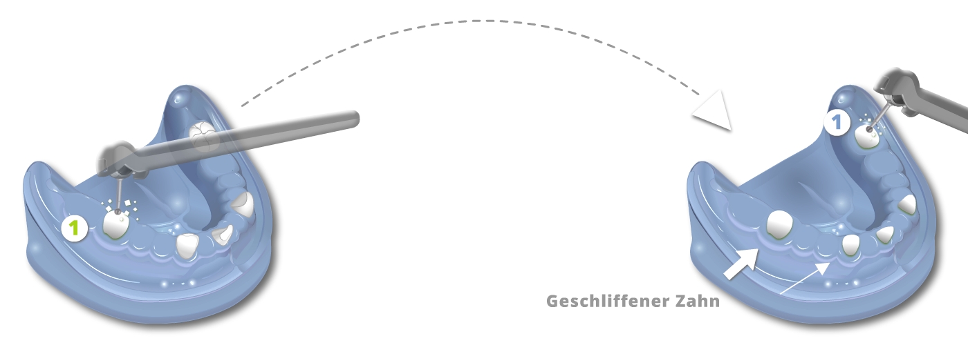 Ästhetischer Zahnersatz - Teleskope aus Vollkeramik