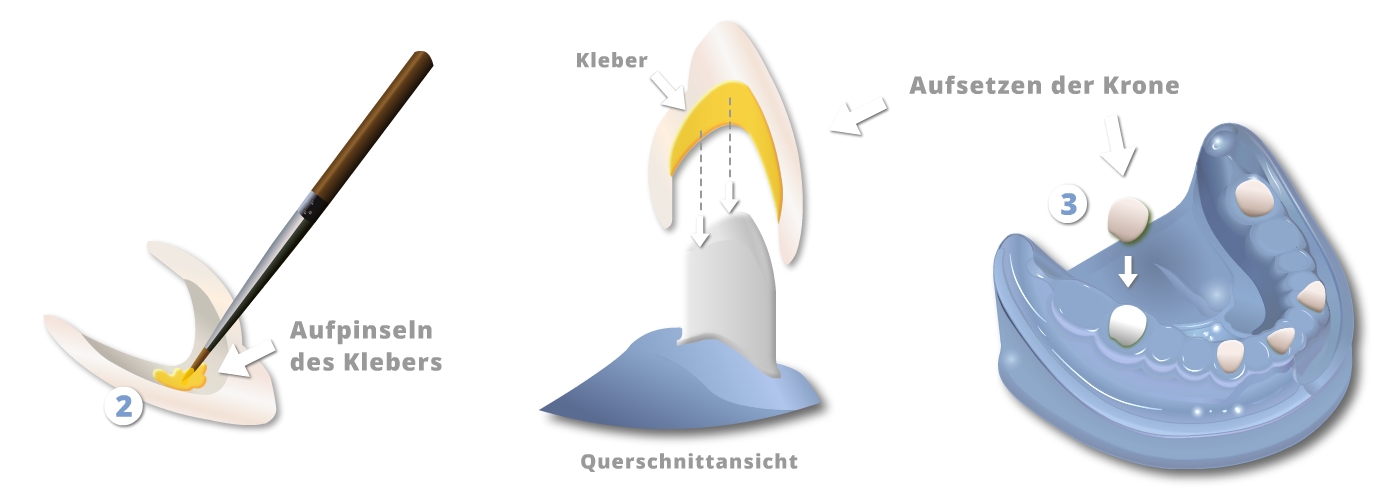 Ästhetischer Zahnersatz - Teleskope aus Vollkeramik