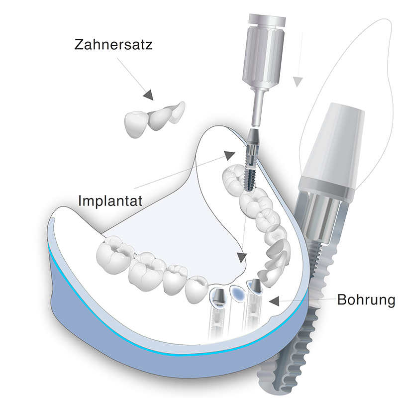 Vorschaubild - Behandlungsmethode der Schaltlücke