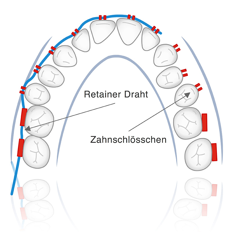 Vorschaubild - Animation Behandlungsmethode Multiband-Apparatur Außenseite