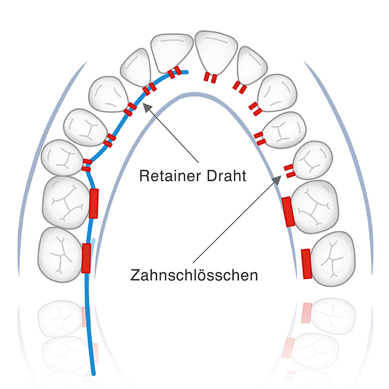 Vorschaubild - Animation Behandlungsmethode Multiband-Apparatur Innenseite